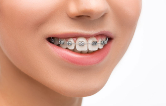 Современные методы коррекции прикуса