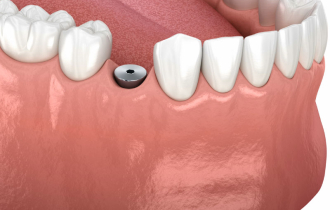 Что такое формирователь десны?