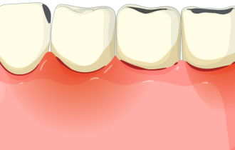 Заболевания дёсен и их влияние на успех имплантации